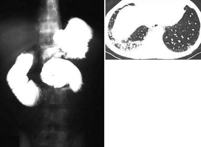 Note also several diverticulae in the small bowel. Left, Barium-meal study shows a dilated duodenum.