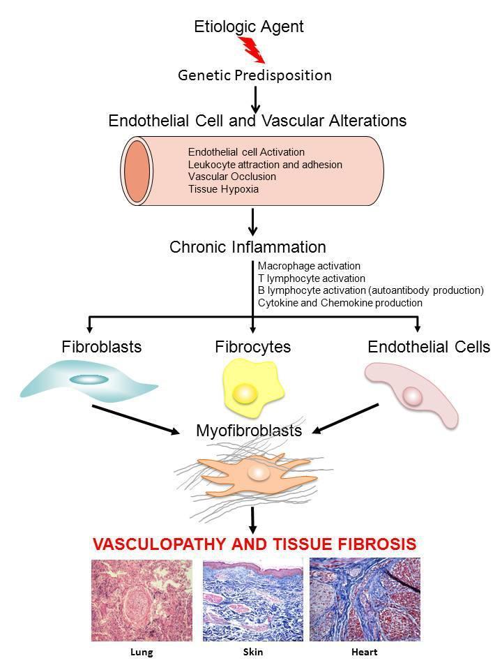 Overall scheme illustrating a current understanding of SSc pathogenesis. Hypothetical sequence of events involved in tissue fibrosis and fibroproliferative vasculopathy in SSc.