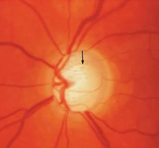 Optic Atrophy Clinical picture Total/partial pale optic disc Well