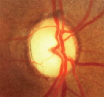 Etiology Vascular (AION, RAO) Inflammation (optic neuritis,