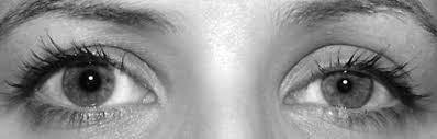 Anhidrosis (diminished sweating) Heterochromia (if