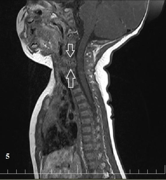 Image 5. T1-weighted +contrast sagittal MRI reveal resolution of the inflammation present before at the level of C5 and C6 vertebral bodies(white arrows).