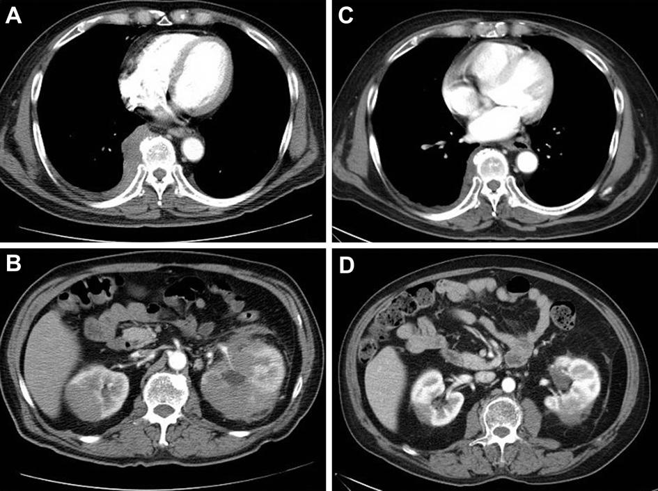 IgG4-related hypophysitis 95 Figure 1 (A) Infiltrating right posterior mediastinal and paraspinal masses with pleural extension; (B) bilateral infiltrating masses in both kidneys; (C) after steroid
