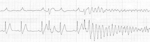 Takashio S Clinical Characteristics of Brugada Syndrome with Ventricular Fibrillation A 3:10 AM 0.46s 0.46s B 3:21 AM V pace 0.44s 0.