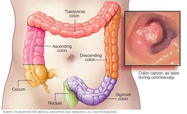 Large bowel obstruction Colon cancer until proven otherwise Relevant hx is if and when they had their last colonoscopy Need