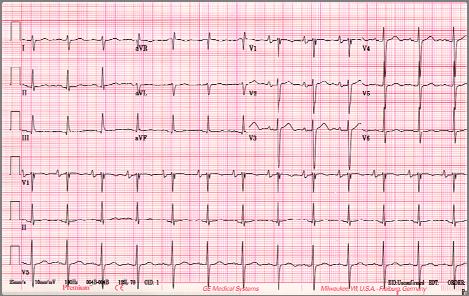 32 yo woman from Viet Nam presents with dyspnea on exertion. What is the diagnosis? The most likely diagnosis is: Biatrial Abnormality A. Primary Pulmonary Hypertension B.
