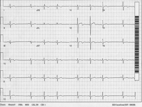 Aortic Stenosis Biatrial Abnormality Non Conducted PAC s o A large diphasic P in V 1 with the positive component > 1.