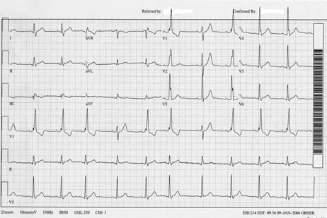 56 yo man presents with flu This ECG represents: Rate-Related