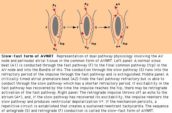 Supraventricular Tachycardias: Which statement is true? Slow-fast form of AVNRT 1.