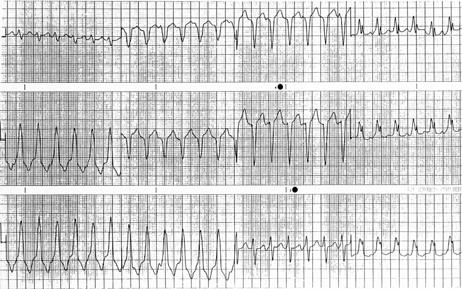 Rx of Hemodynamically stable tachycardia 34 yo woman with idiopathic cardiomyopathy became dizzy and came to the ED. Wide QRS-complex tachycardia (QRS > 120 ms) Regular or irregular?