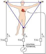 Einthoven s Triangle - ECG RA RL Cable Reversal (-) (+)