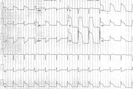 43 yo obese man admitted with chest pain.