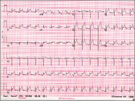 Acute Pericarditis 45 yo woman with nausea and vomiting RBBB Which of the following is not true about RBBB? A.