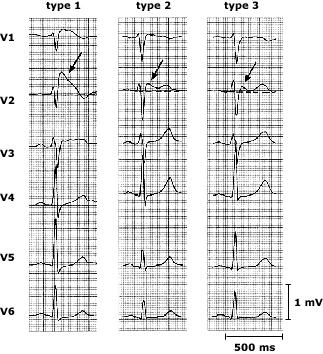 syncope due to polymorphous VT (1990) Hereditary bundle