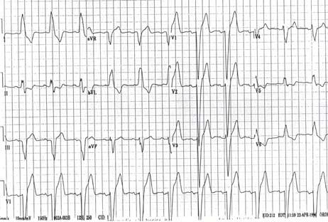 In most patients with LBBB, septal wall motion abnormalities can exist without coronary artery disease C.