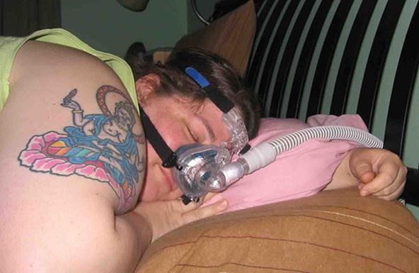 Difficult Clinical Scenario #1 Obstructive Sleep Apnea Higher risk of respiratory complications post-op Strongly push for neuraxial or regional technique