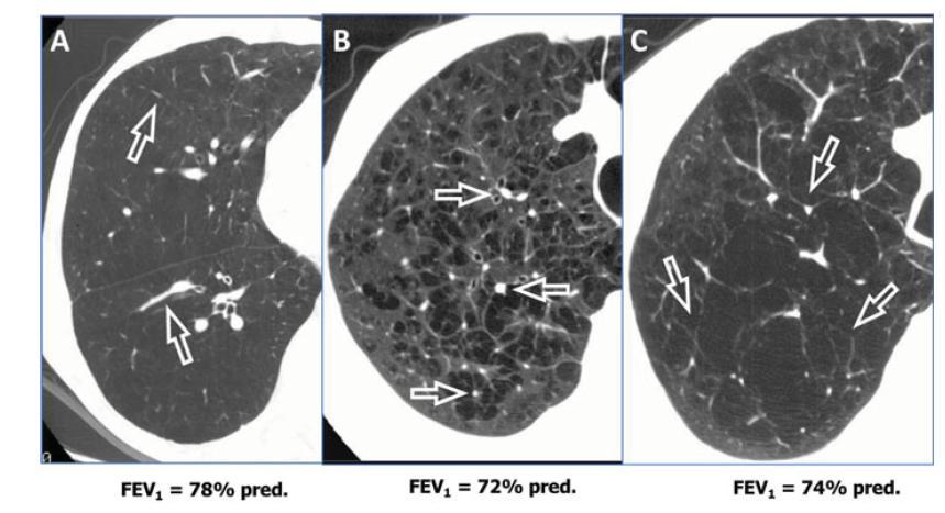 Different COPD cases with similar functional