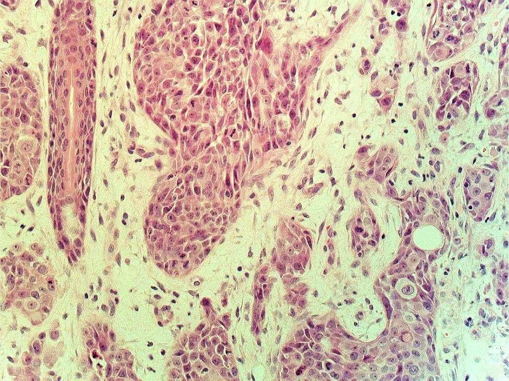 BSD 2015 Case 19 mixed tumour of skin differential diagnosis: porocarcinoma