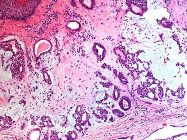 BSD 2015 Case 19 mixed tumour of skin (chondroid syringoma) Histological features: Apocrine > eccrine Mulilobulated Well circumscribed Variable nests, cords, glandular structures,