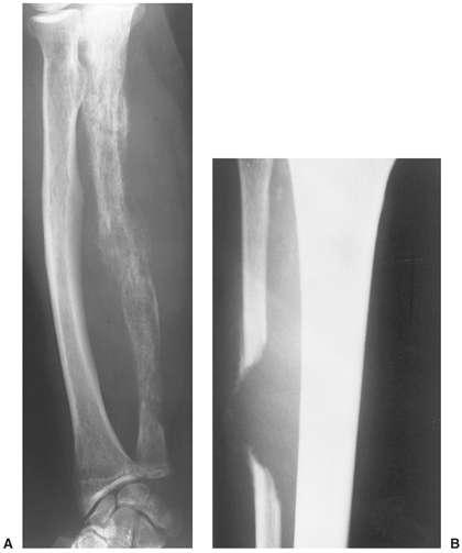 Metastases distal to the elbows and the knees.