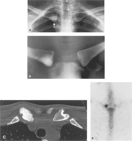 Condensing osteitis of the clavicle. A: Radiograph shows a sclerotic lesion in the inferior aspect of the right clavicle (arrow), originally thought to represent sclerotic metastasis.