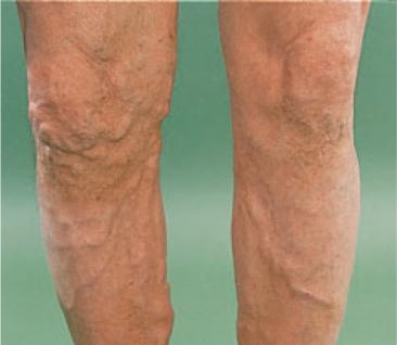 Varicose veins are a
