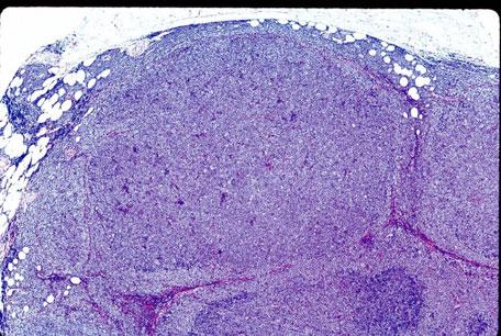 Malignant follicular center cell proliferation B.