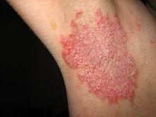 Calcium signaling and disease Hailey-Hailey disease and Darier disease - Skin diseases caused by mutations of a new family of