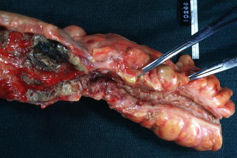 Gross Pathology Mucosal edema