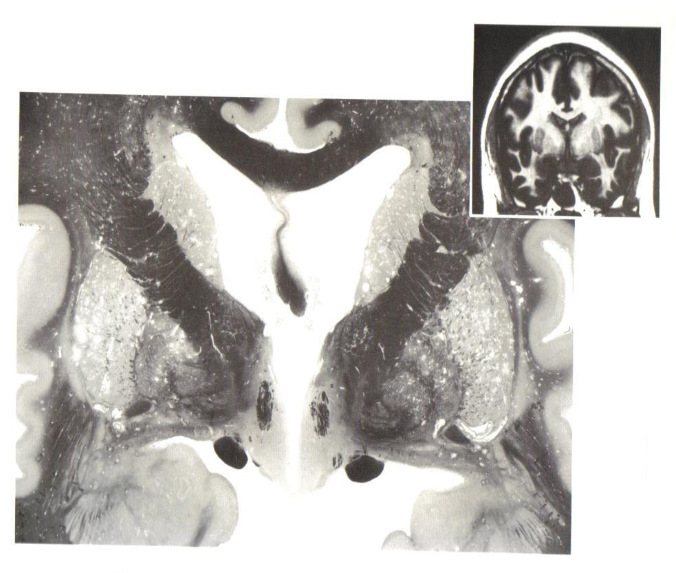 Basal Ganglion, Thalamus, Hypothalamus Hanes DE.