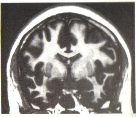 Basal Ganglion, Thalamus, Hypothalamus MR View Hanes DE.