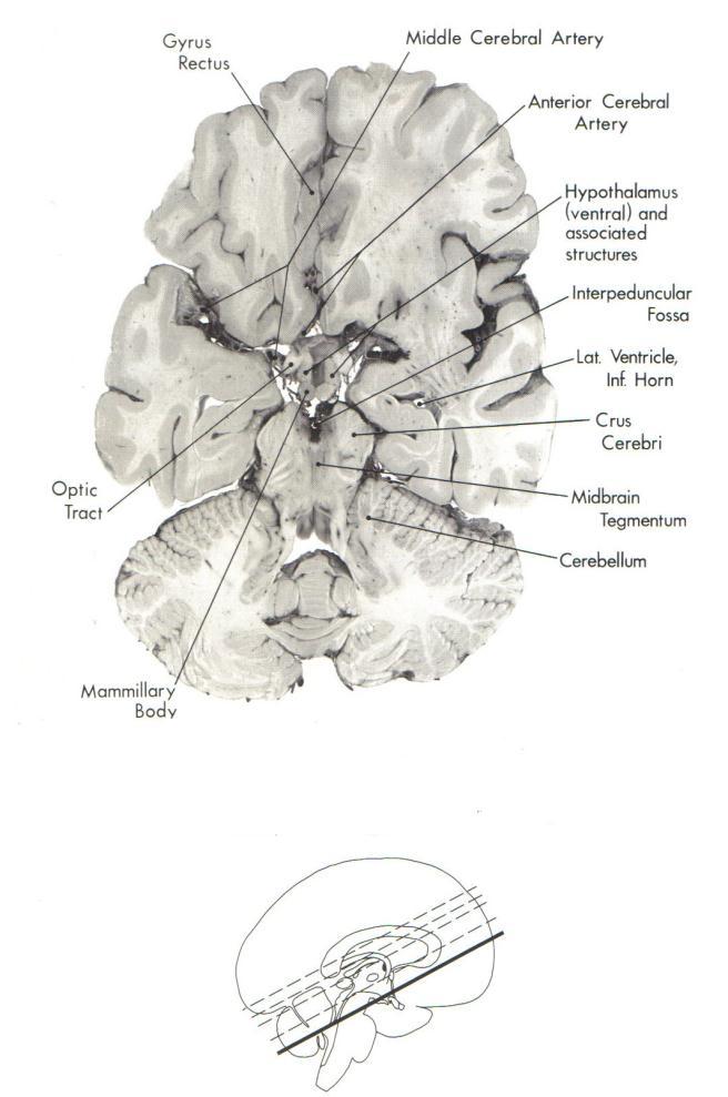 Brainstem CT and MR View