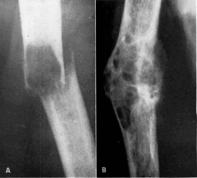 CANCER July 1948 FIG. 2. A, Lytic type cancer metastasis in the shaft of the humerus with pathological fracture. B, After roentgen-ray treatment the fracture healed.