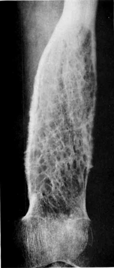 Symmetry in Bone, This term refers to the position of the tumor relative to the long axis of the bone in both sagittal and lateral projections and applies specifically to tumors in the tubular bones.