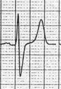 2-5, rarely in V 6 8 Hyperkalemia EKG changes more reflective of rate