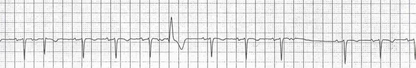 Atrial Flutter Atrial Flutter Continuous regular atrial activity Re-entrant atrial circuit Flutter waves must have identical morphology subtract for confounding effects of QRS, ST segment, T wave