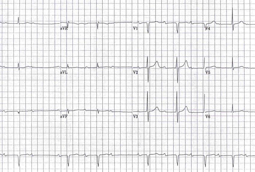 Multifocal Atrial Tachycardia Multifocal Atrial Tachycardia MAT: an irregularly irregular rhythm P waves with 3 morphologies per lead Mean atrial