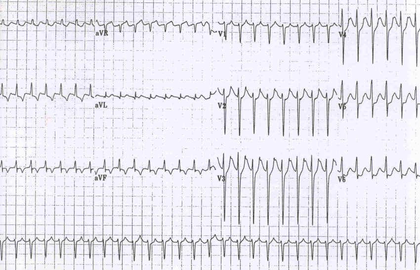 ?? Third Degree A-V Block Complete failure of atrial impulse propagation with independent junctional or ventricular escape rhythm P waves and QRS complexes