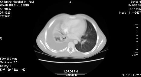 IO Chest CT on admit with unilateral pleural effusion