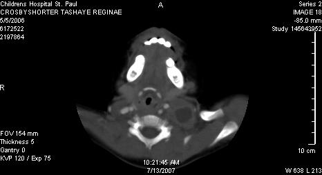 non-compliance Neck CT showing large necrotic left cervical nodes 4 months