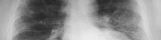 pattern DDX: Pulmonary edema, interstitial lung diseases (ex.