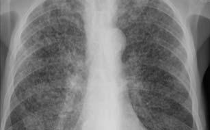 Miliary TB Insidious in