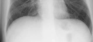 x-ray Sputum smear for AFB