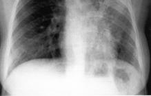Active pulmonary TB: HIV vs.