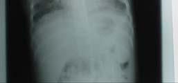 pleural cavity tubercles