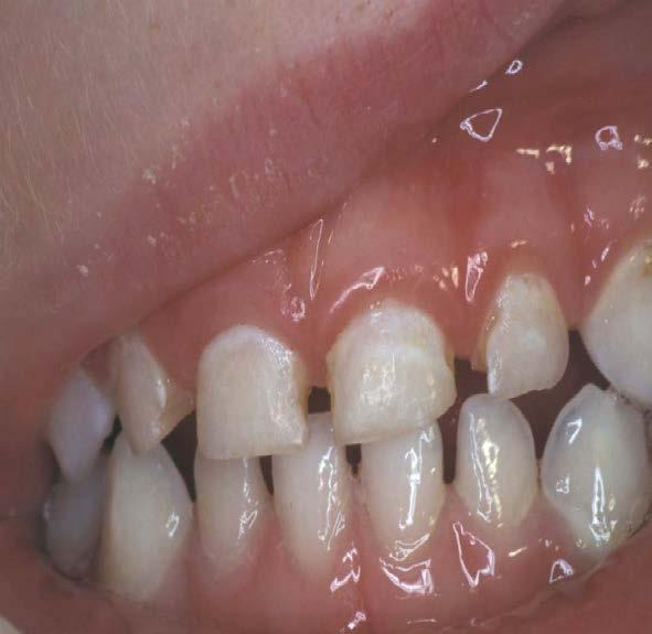 White spots indicate acids have demineralized enamel First clinical signs of caries White spots