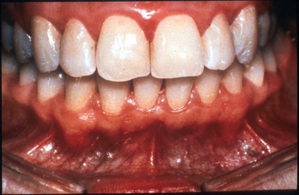 Gingivitis 42 Mildest form of PD Mild gum swelling, tenderness, erythema Gums bleed during