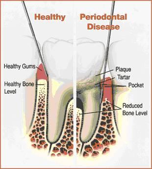 More severe than gingivitis Chronic Periodontitis Infection and inflammation induce loss of bone and tooth attachment Rare in children,
