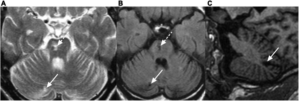 best seen on the sagittal reconstruction of the 3-dimensional T1-weighted images (C).