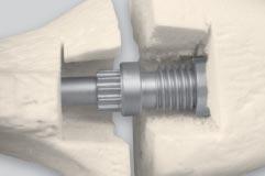 Implant Assembly Position the Compression Screw Component on the small diameter of the Tibial Component with its screw threads placed into the Femoral Component (Figure 13).